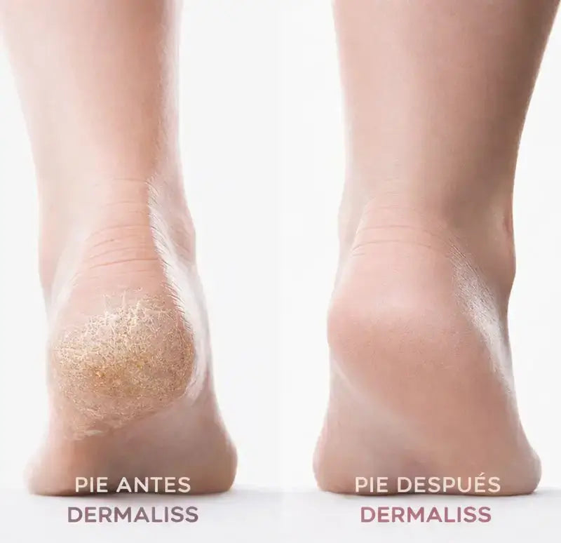 DermaLiss® LUVE - Removedor de Callos